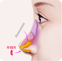 짧은코 성형 연골성형술+연골이식술+융비술