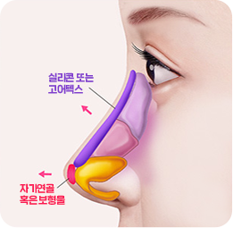 휜코 성형 보형물 삽입