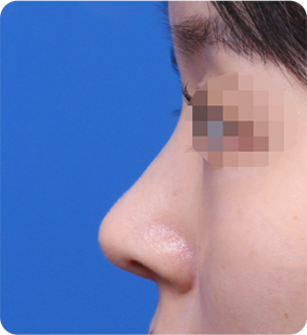 무보형물 코성형 수술 후