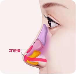 무보형물 코성형 자가연골만 사용