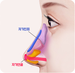무보형물 코성형 연골과 자가진피로 수술한 경우