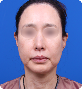 안면거상 정면 전