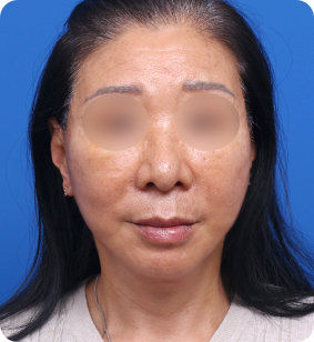 전체 안면거상 정면 후