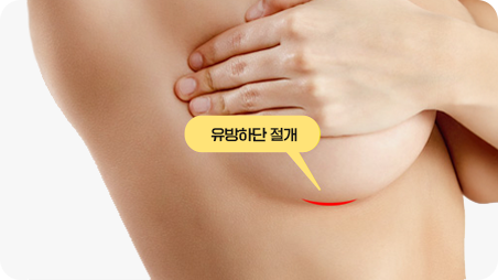 밑선 절개법