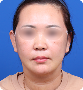 미니거상 정면 후