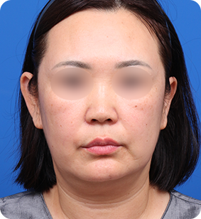 미니거상 정면 전