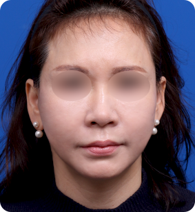 세미거상 정면 후