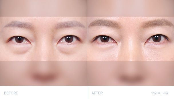 눈밑지방재배치 전후 비교 1